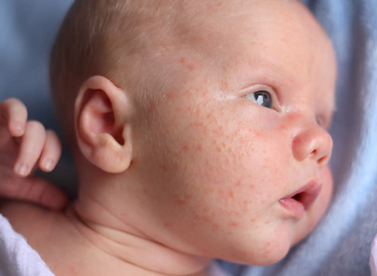 Understanding Newborn Baby Rashes: Causes, Types, and Care